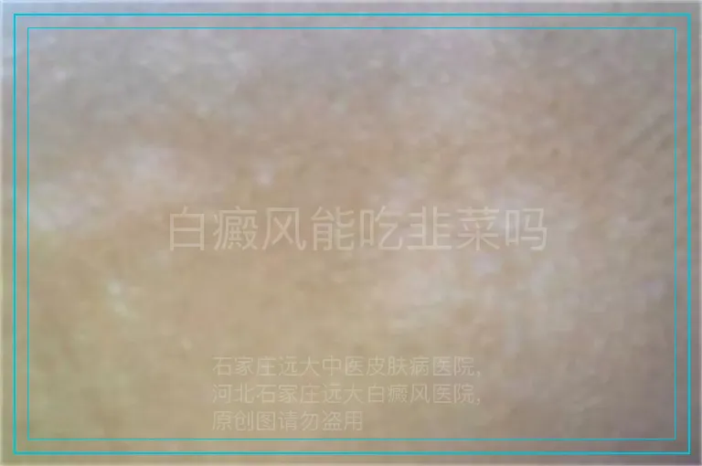 白癜风能吃韭菜吗