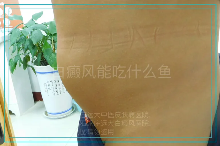 白癜风能吃什么鱼