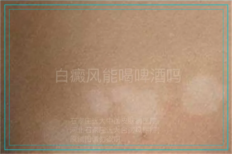白癜风能喝啤酒吗