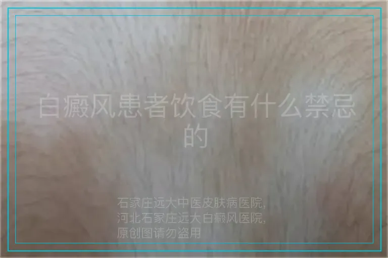 白癜风患者饮食有什么禁忌的