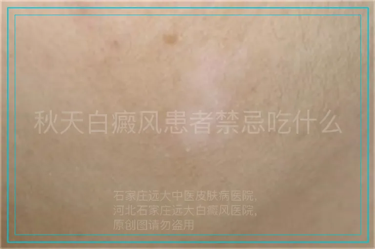 秋天白癜风患者禁忌吃什么