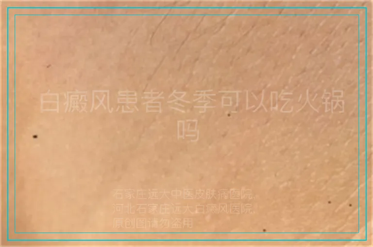  白癜风患者冬季可以吃火锅吗