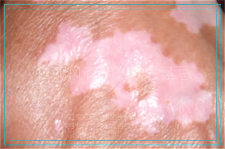 白癜风有什么饮食禁忌