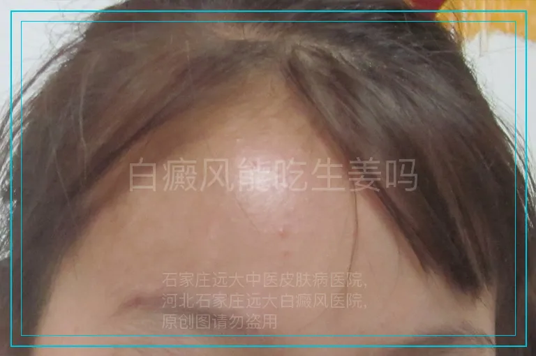 白癜风能吃生姜吗
