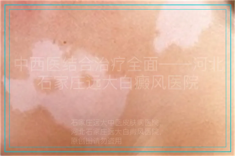 中西医结合治疗全面——河北石家庄远大白癜风医院