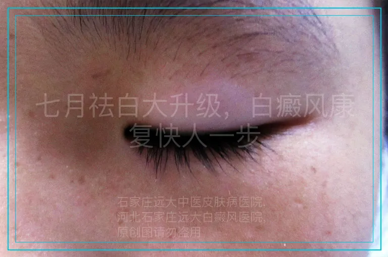 七月祛白大升级，白癜风康复快人一步