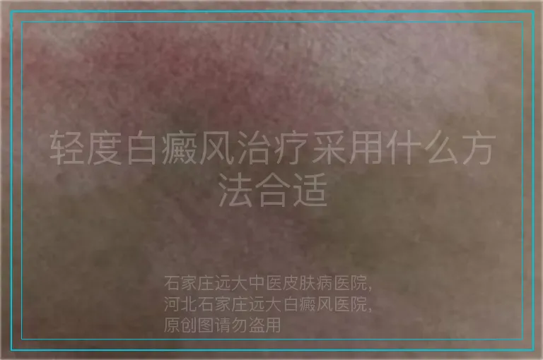 轻度白癜风治疗采用什么方法合适