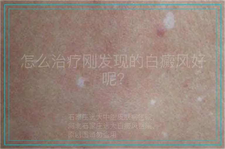 怎么治疗刚发现的白癜风好呢?