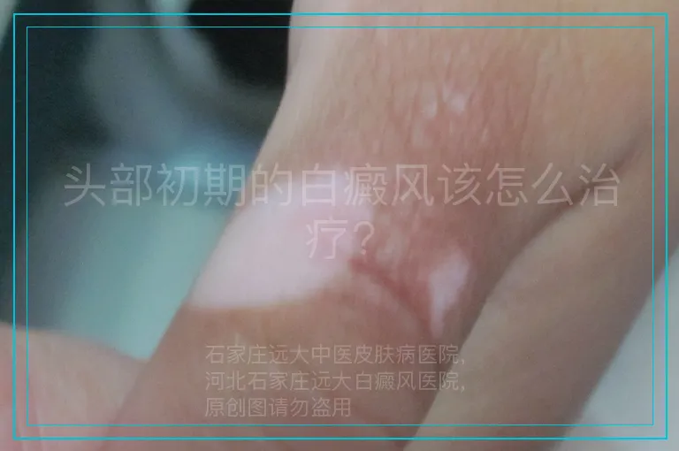 头部初期的白癜风该怎么治疗?