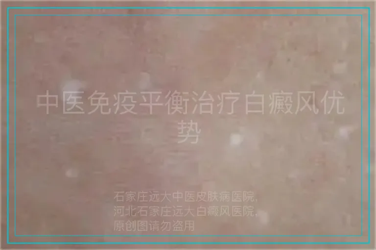 中医免疫平衡治疗白癜风优势