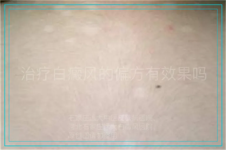 治疗白癜风的偏方有效果吗