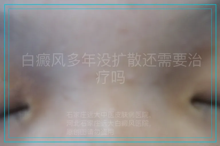 白癜风多年没扩散还需要治疗吗
