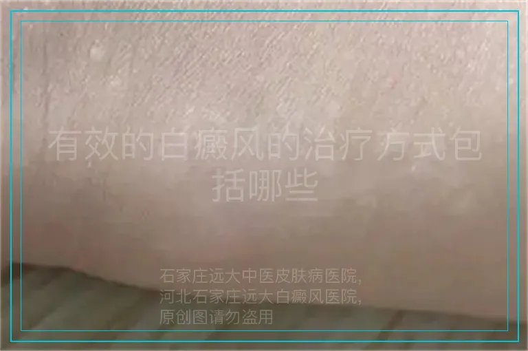 有效的白癜风的治疗方式包括哪些