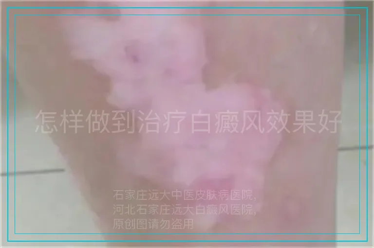 怎样做到治疗白癜风效果好