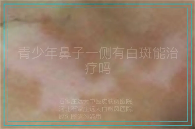 青少年鼻子一侧有白斑能治疗吗