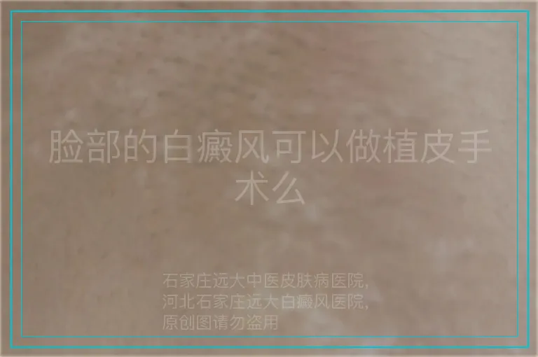 脸部的白癜风可以做植皮手术么