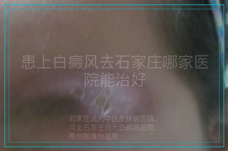 患上白癜风去石家庄哪家医院能治好