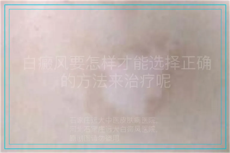 白癜风要怎样才能选择正确的方法来治疗呢