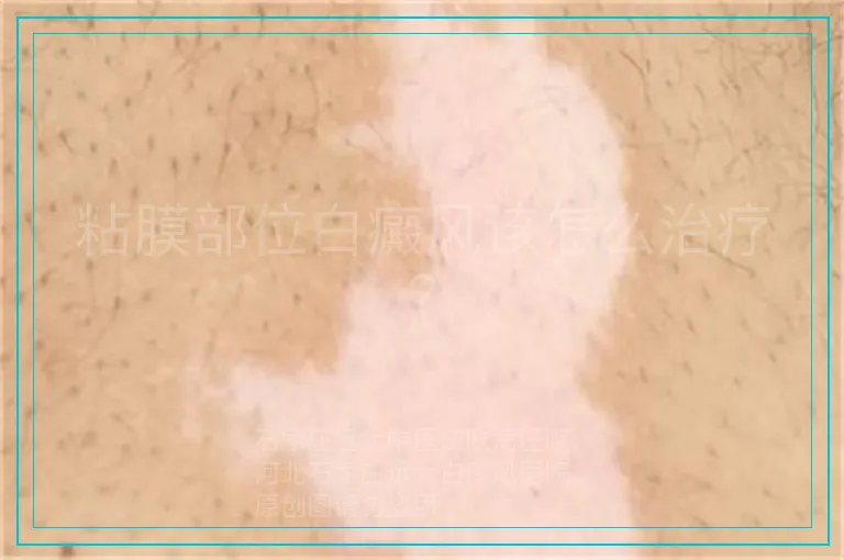 粘膜部位白癜风该怎么治疗？