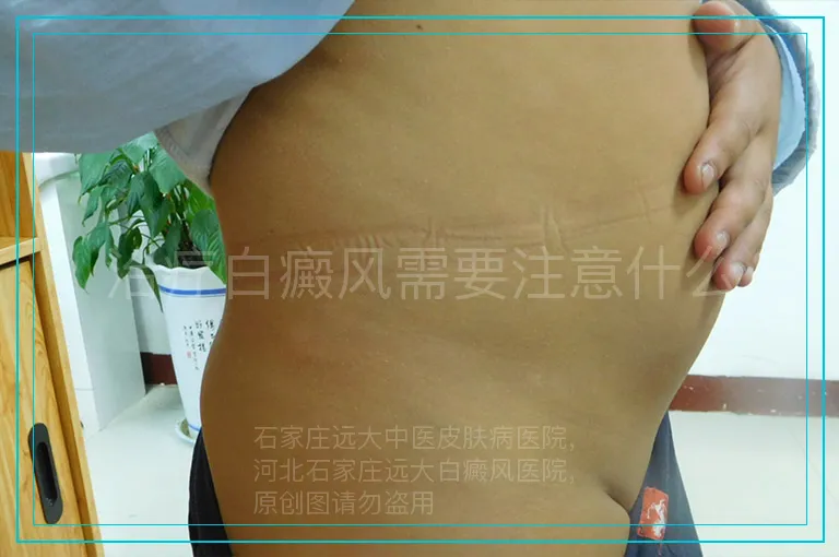 治疗白癜风需要注意什么