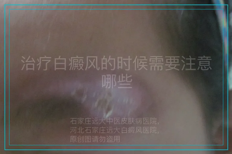 治疗白癜风的时候需要注意哪些