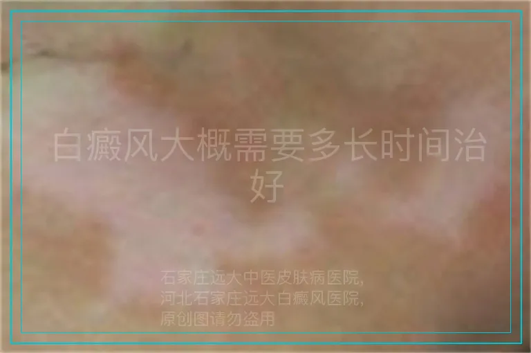 白癜风大概需要多长时间治好