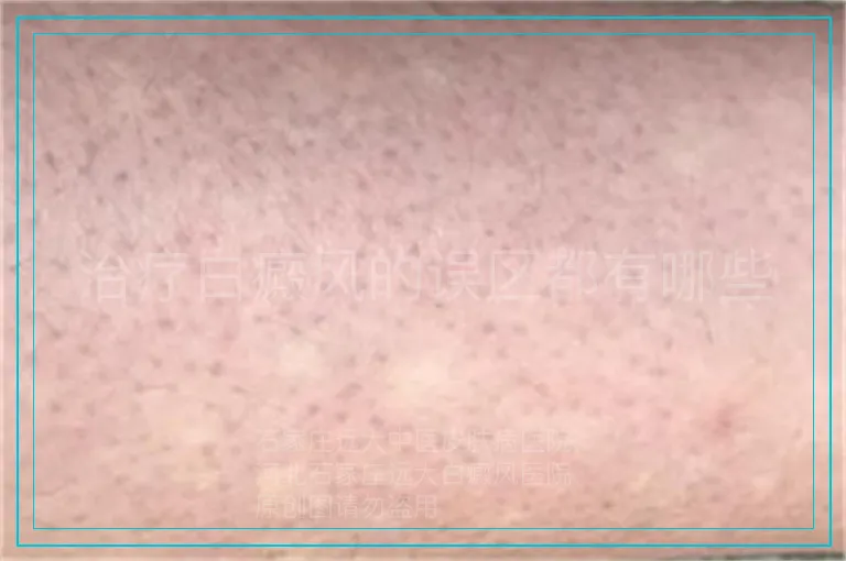 治疗白癜风的误区都有哪些