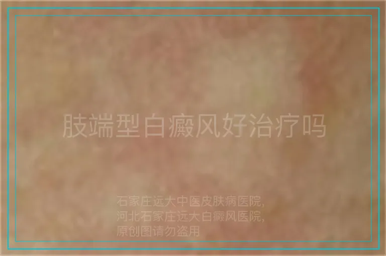 肢端型白癜风好治疗吗