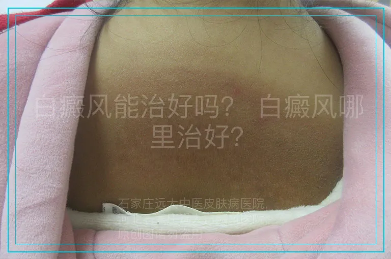 白癜风能治好吗? 白癜风哪里治好?