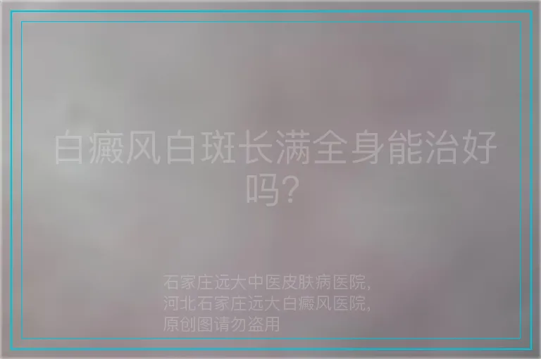 白癜风白斑长满全身能治好吗?