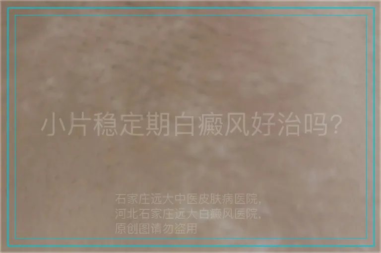 小片稳定期白癜风好治吗?