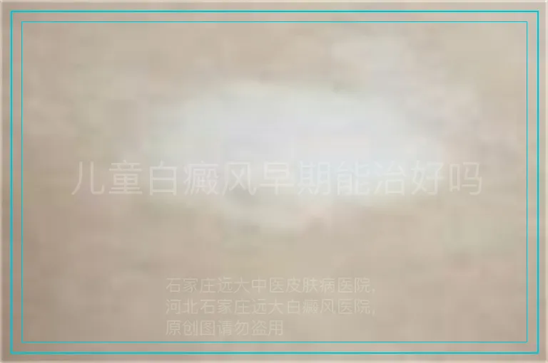 儿童白癜风早期能治好吗
