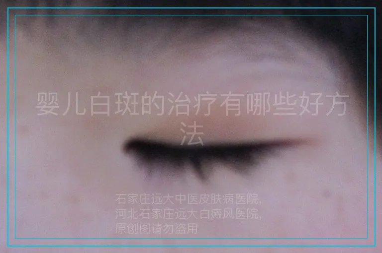 婴儿白斑的治疗有哪些好方法