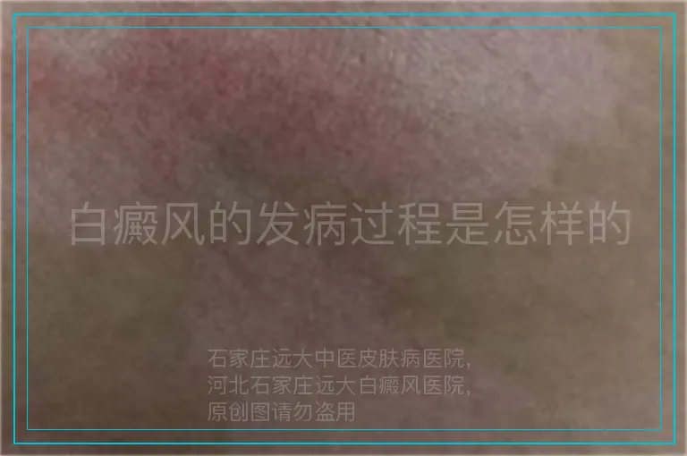 白癜风的发病过程是怎样的