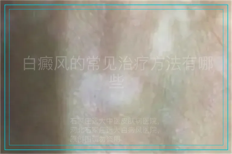 白癜风的常见治疗方法有哪些