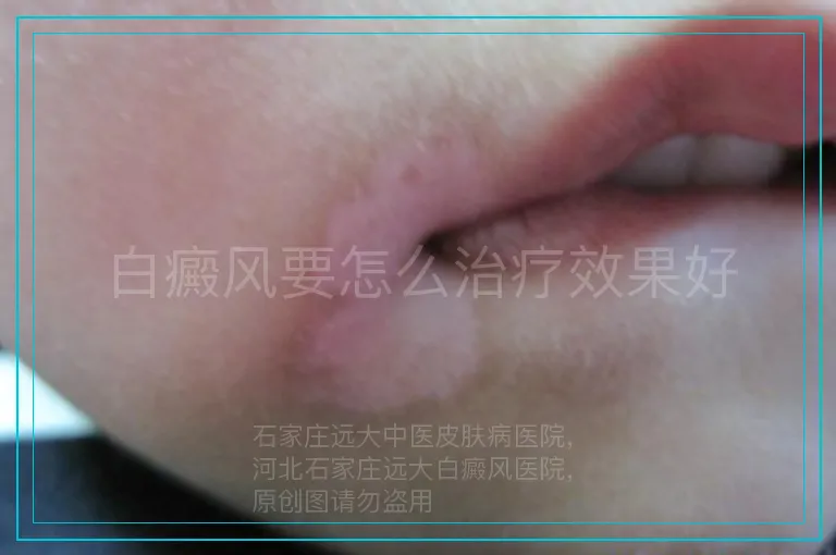 白癜风要怎么治疗效果好