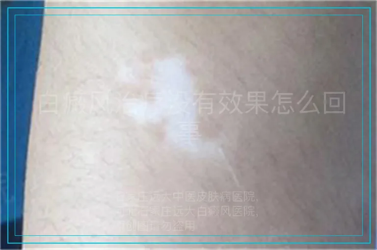 白癜风治疗没有效果怎么回事