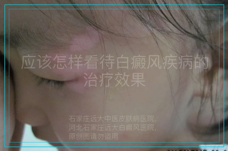 应该怎样看待白癜风疾病的治疗效果