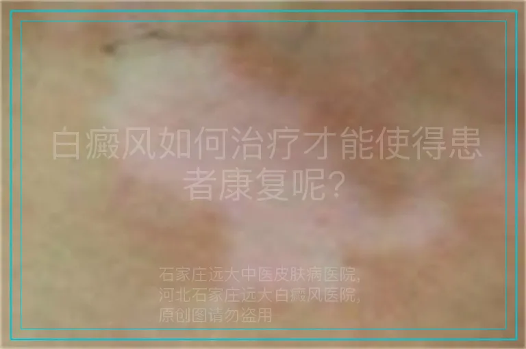 白癜风如何治疗才能使得患者康复呢?