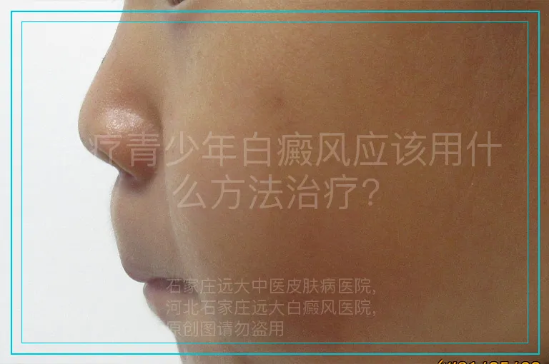 治疗青少年白癜风应该用什么方法治疗?