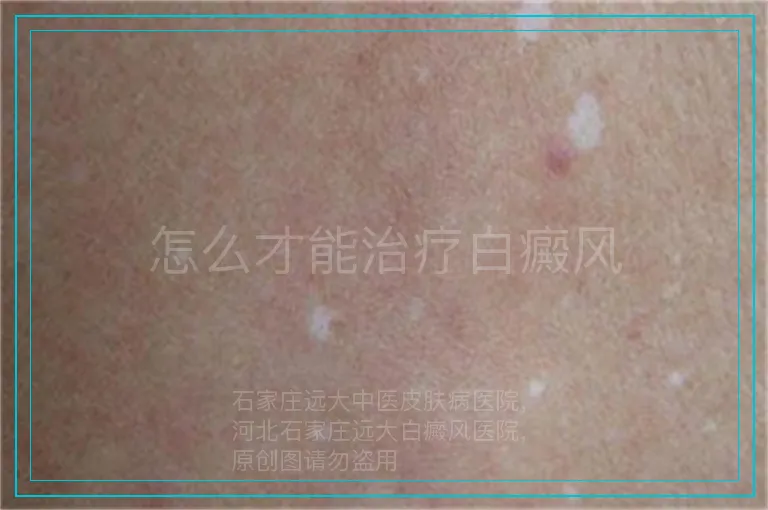 怎么才能治疗白癜风