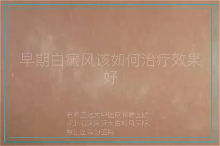 早期白癜风该如何治疗效果好