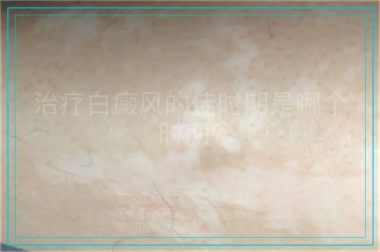 治疗白癜风的佳时期是哪个时期?