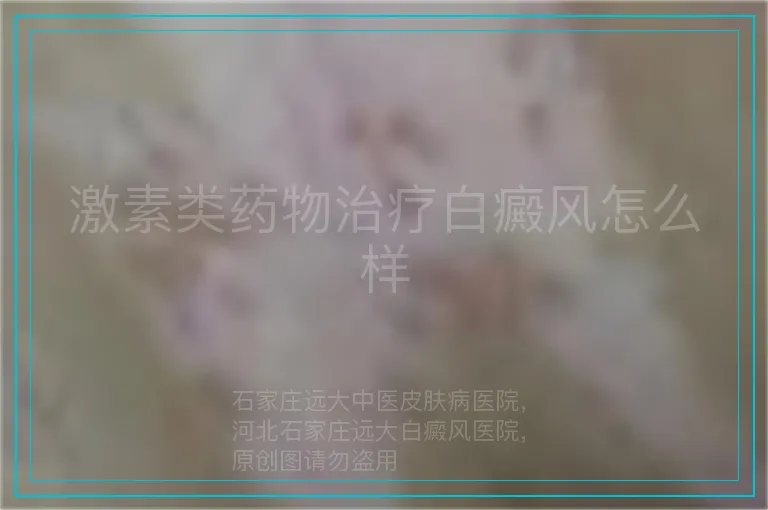 激素类药物治疗白癜风怎么样
