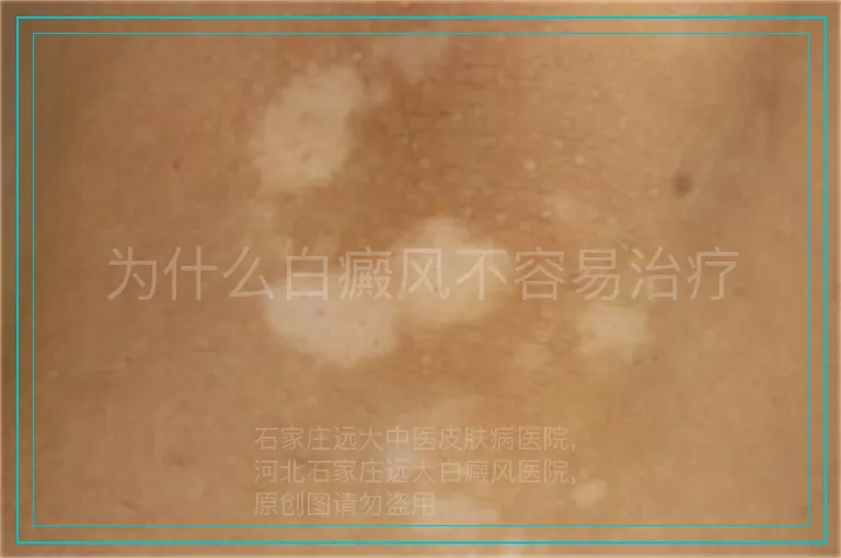 为什么白癜风不容易治疗