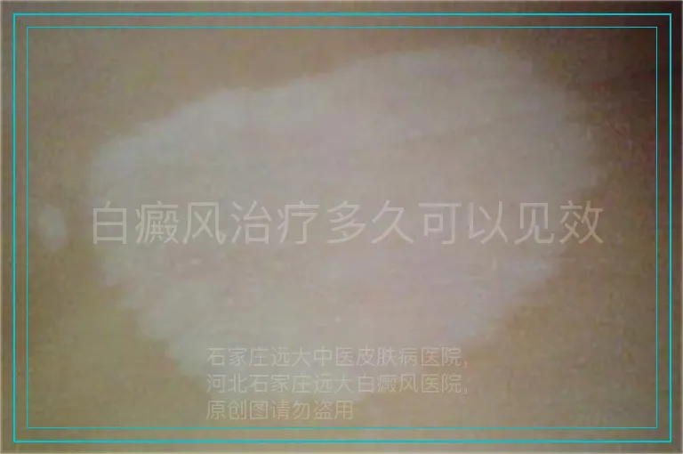 白癜风治疗多久可以见效