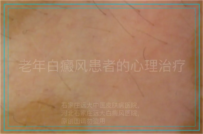 老年白癜风患者的心理治疗