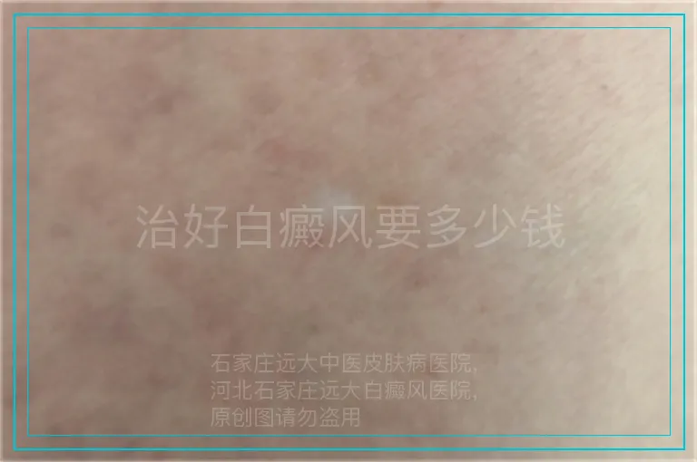 治好白癜风要多少钱