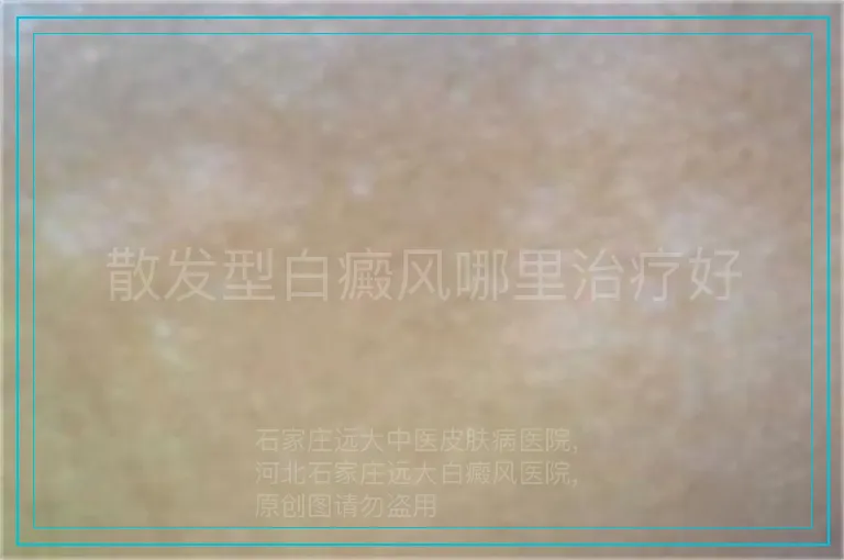 散发型白癜风哪里治疗好