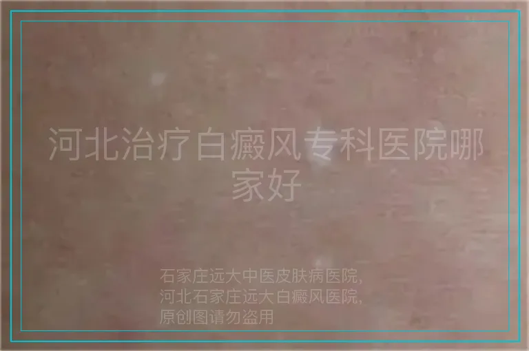 河北治疗白癜风专科医院哪家好